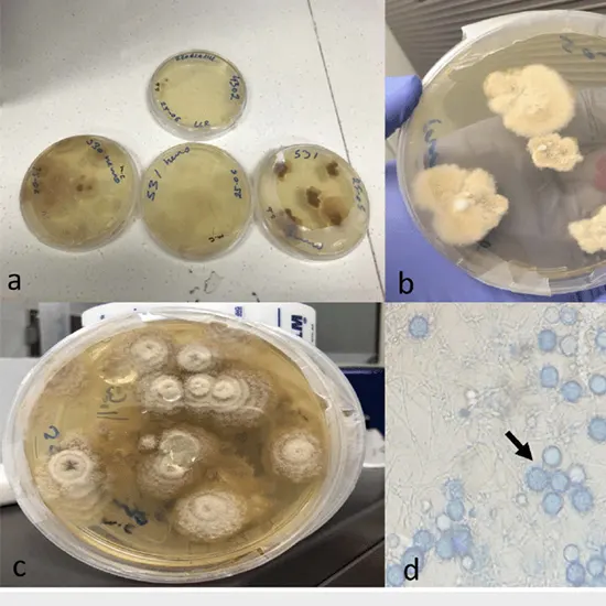 Cerebrospinal Fluid (CSF) for Fungus Culture